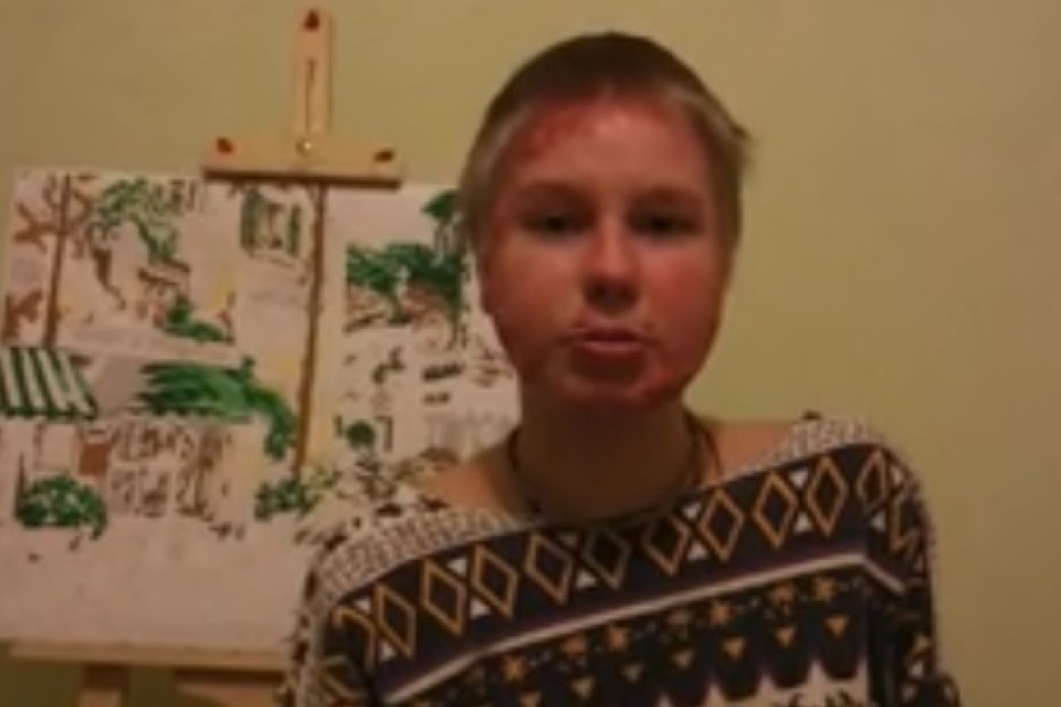 Девочку, обожженную при взрыве газа в Харькове, отправят на лечение в Германию