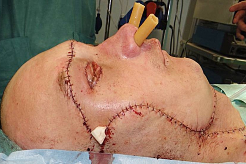 Шокирующие фото: в Польше мужчине пересадили лицо
