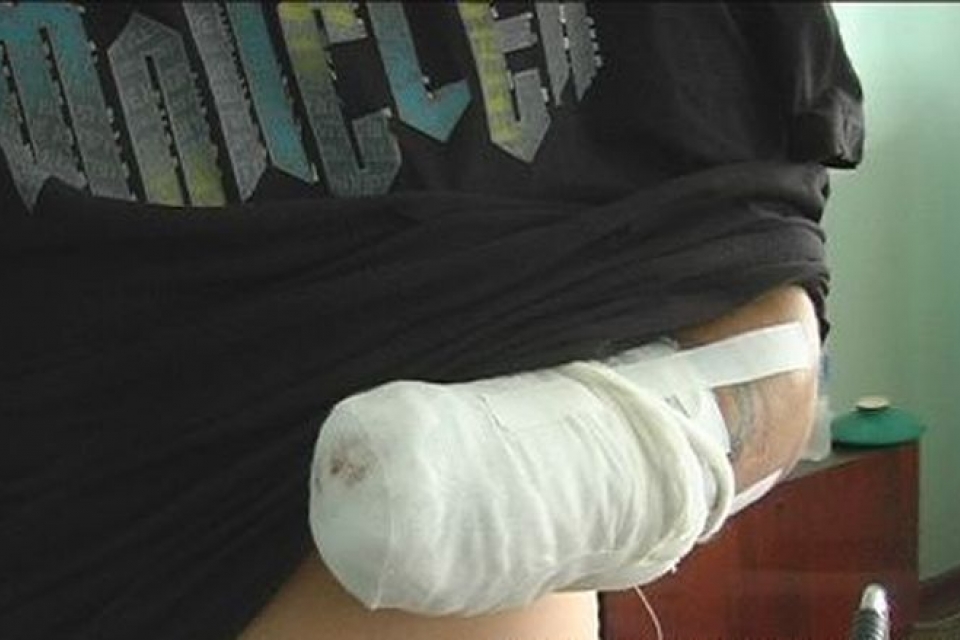 На Луганщине пьяному мужчине взрывом оторвало руку