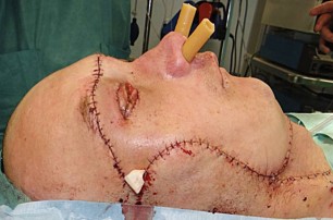 Шокирующие фото: в Польше мужчине пересадили лицо