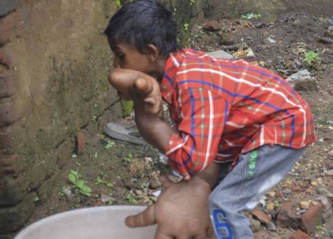 В Индии живет мальчик с руками больше, чем голова