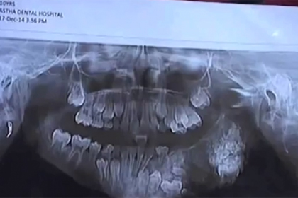 Семилетнему мальчику из Индии удалили 80 зубов