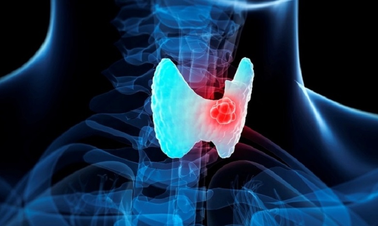 Рак щитовидной железы: диагностика и симптоматика