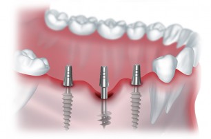 Безопасна ли одномоментная имплантация зубов