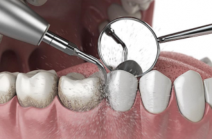 Професійна гігієна ротової порожнини: чистка зубів